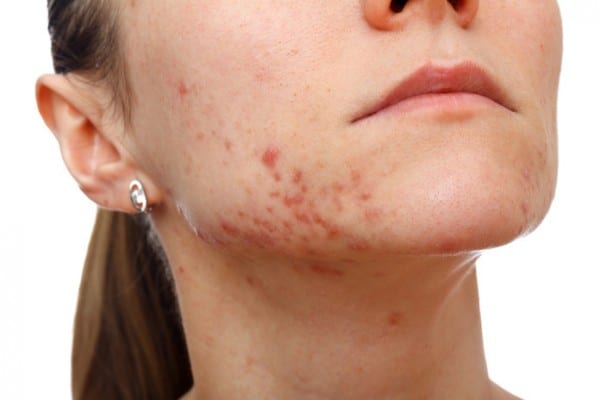 Come coprire le cicatrici da acne